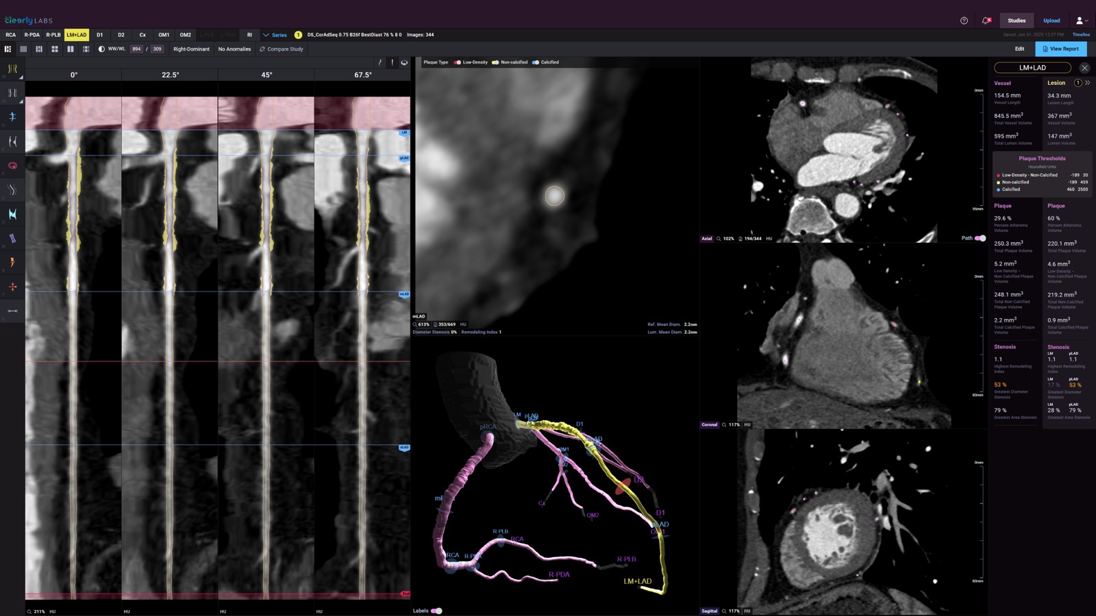 Cleerly AI coronary plaque analysis — color-coded plaque visualization showing left main and left anterior descending coronary arteries with cross-sectional detail