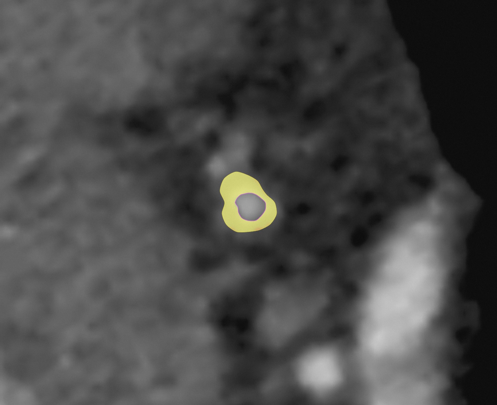 AI coronary plaque analysis